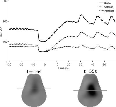 Perflubron Distribution During Transition From Gas to Total Liquid Ventilation